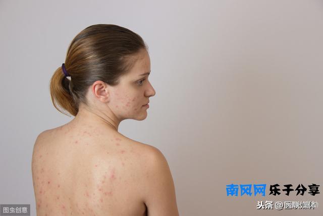 痘痘“蔓延”到了背上？教你四招，解决背部痘痘