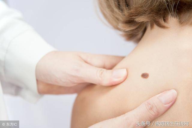 点痣之后要注意什么(点痣之后不能吃什么)