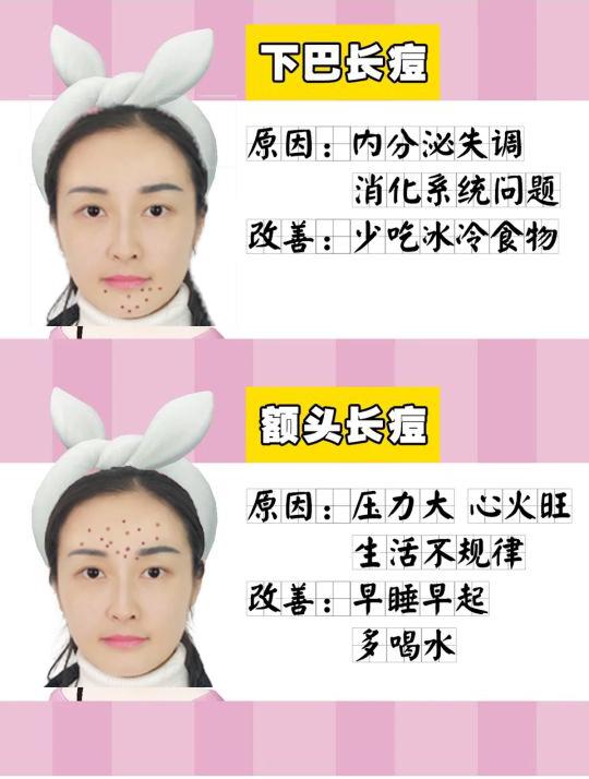 脸部长痘原因分布图（脸上长痘不同位置图解）