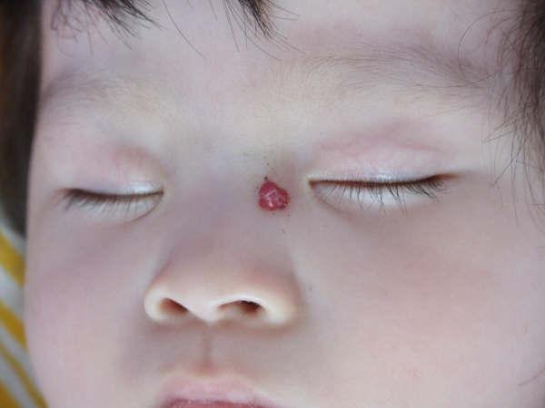 红痣是什么原因（红痣和血痣的区别）