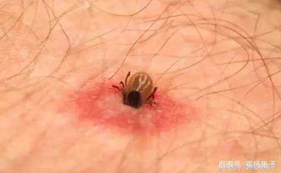 蜱虫是什么，被蜱虫咬伤为什么会丧命？不知道这两点，夏天很危险