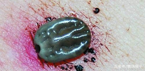 蜱虫是什么，被蜱虫咬伤为什么会丧命？不知道这两点，夏天很危险