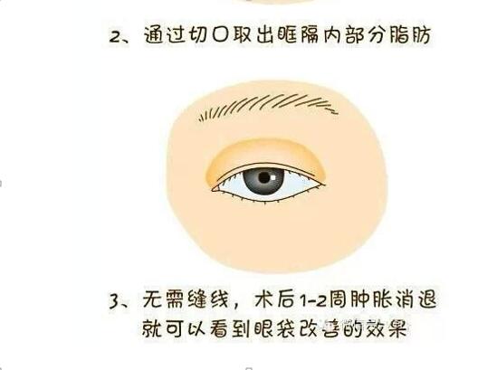 卧蚕是什么（卧蚕和眼袋的区别）