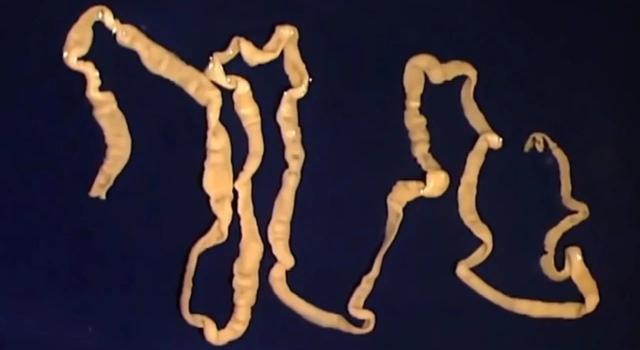 麦地那龙线虫病的症状(麦地那龙线虫图片)