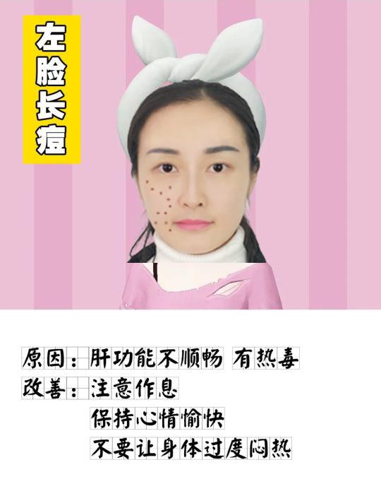 脸部长痘原因分布图（脸上长痘不同位置图解）