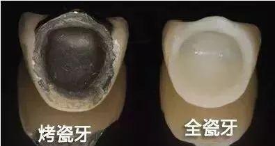 非金属烤瓷牙多少钱一粒（烤瓷牙哪种好）