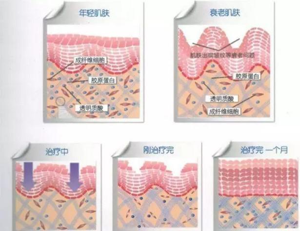 热玛吉价格多少钱，千万别掉坑