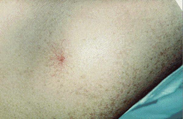 红痣是什么原因（红痣和血痣的区别）