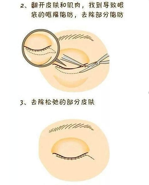 卧蚕是什么（卧蚕和眼袋的区别）