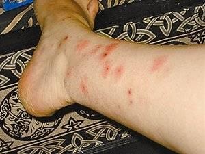 被臭虫咬的症状图片（被臭虫咬了擦什么药）