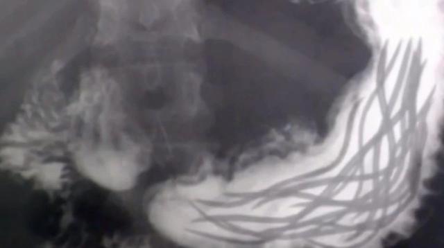 麦地那龙线虫病的症状(麦地那龙线虫图片)