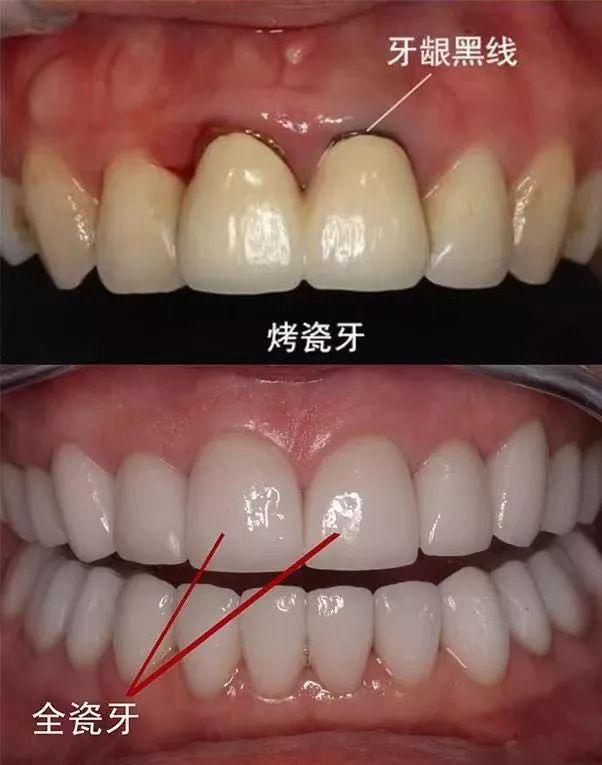 非金属烤瓷牙多少钱一粒（烤瓷牙哪种好）