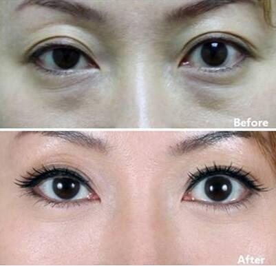 热玛吉价格多少钱，千万别掉坑