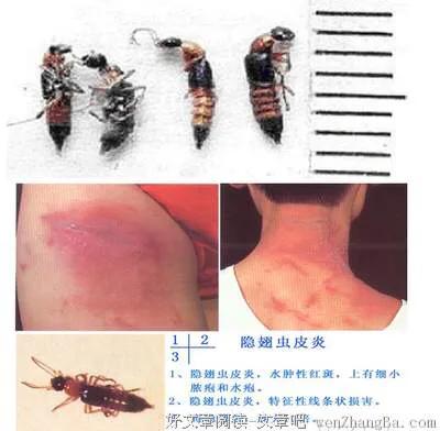 隐翅虫咬人后图片（毒隐翅虫咬到初期图片）