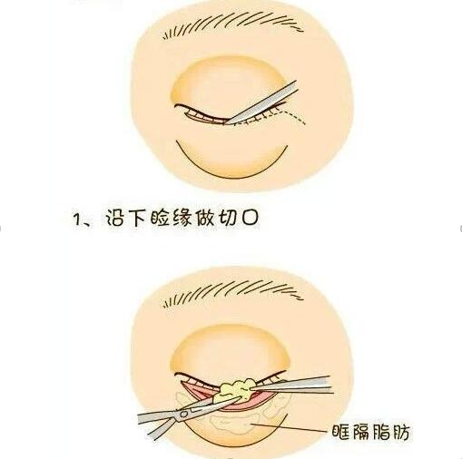 卧蚕是什么（卧蚕和眼袋的区别）