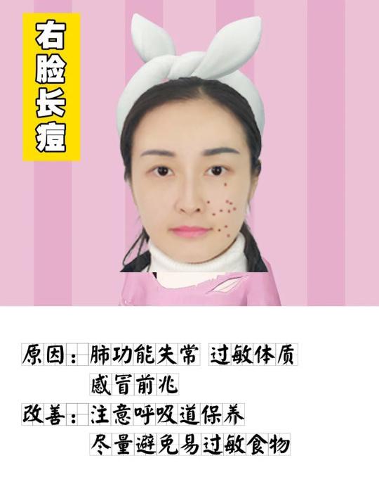 脸部长痘原因分布图（脸上长痘不同位置图解）