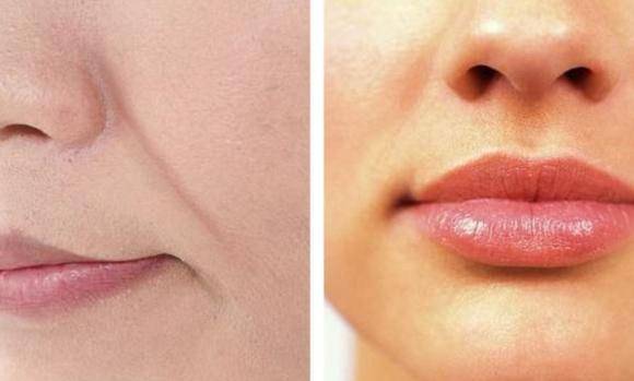 法令纹明显怎么办（法令纹越来越明显这样做）